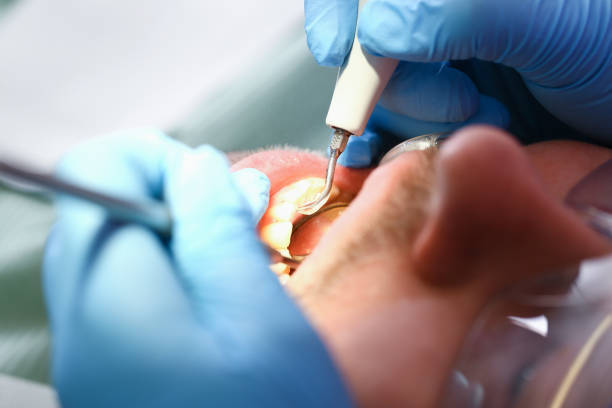 Best Emergency Dental Care for Broken or Chipped Teeth in Hallstead, PA
